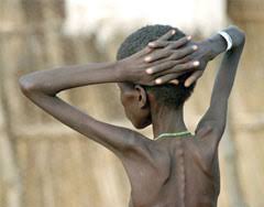 malnutrition